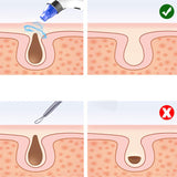 Electric Blackhead Remover Vacuum for Facial Beauty